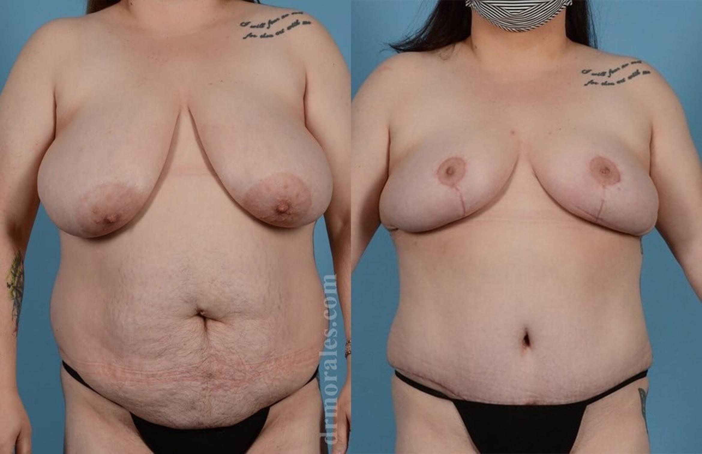 Before & After Breast Reduction Case 643 View 1 View in Houston, TX