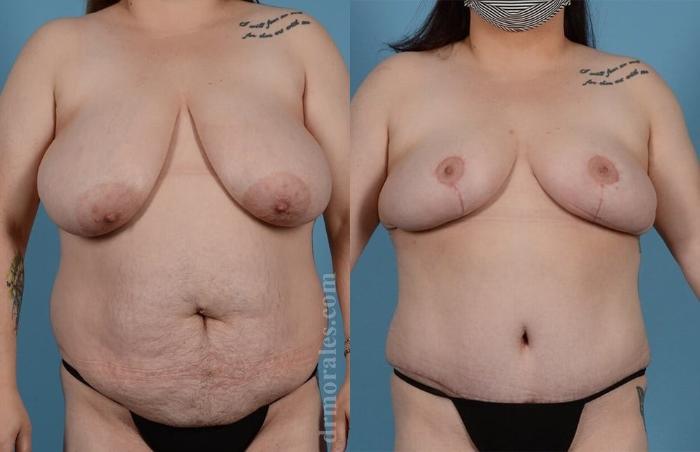 Before & After Breast Reduction Case 643 View 1 View in Houston, TX