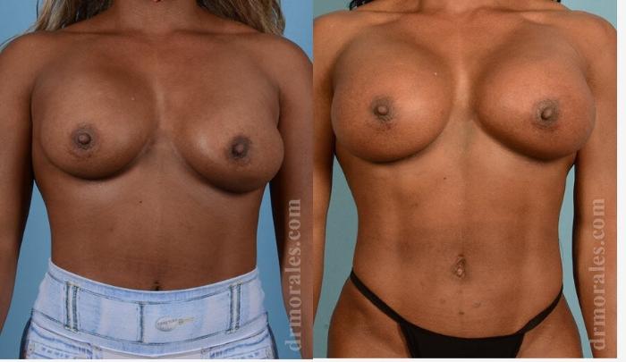 Before & After Breast Revision Case 27 View 1 View in Houston, TX