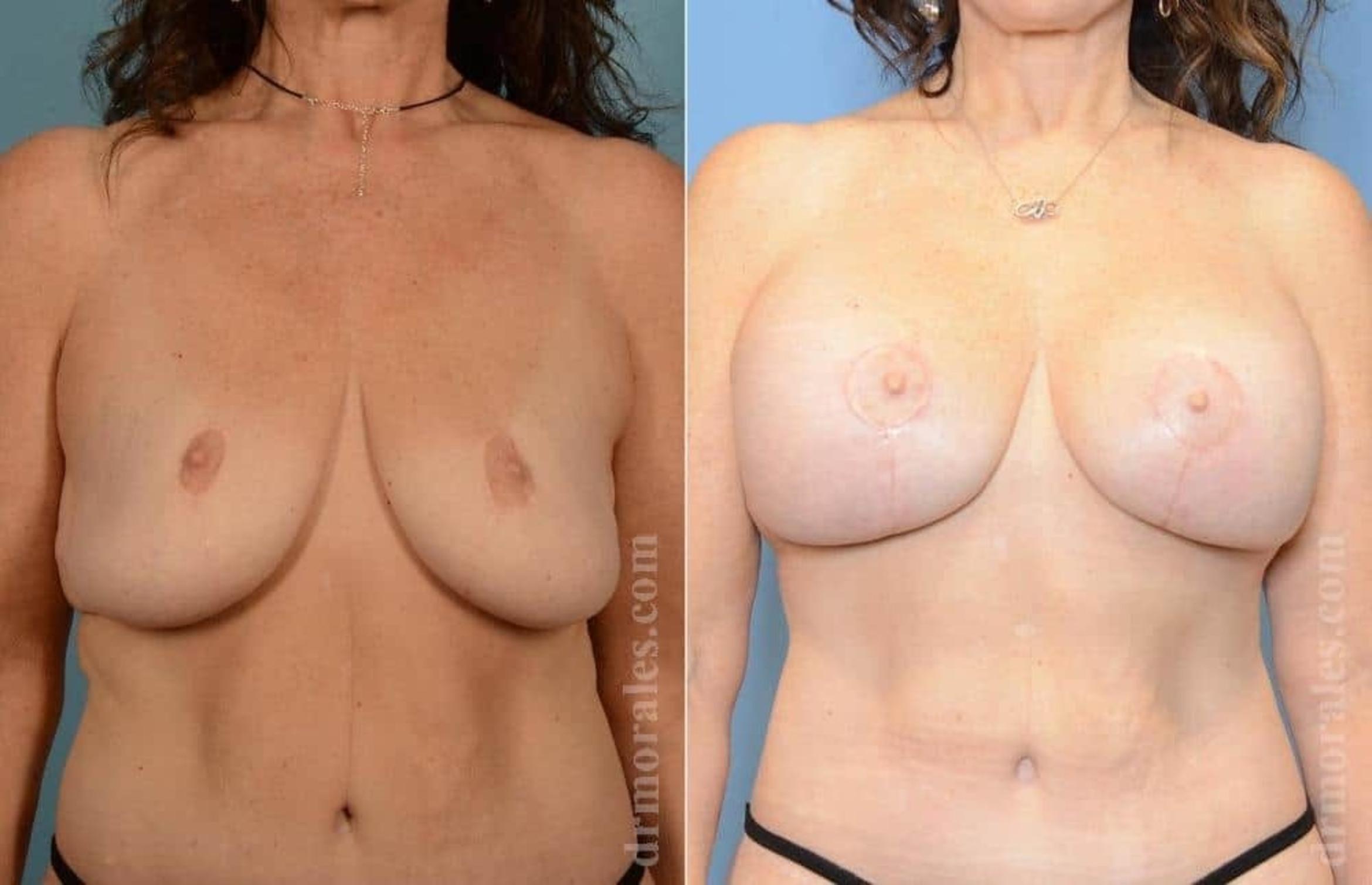 Before & After Breast Revision Case 43 View 1 View in Houston, TX