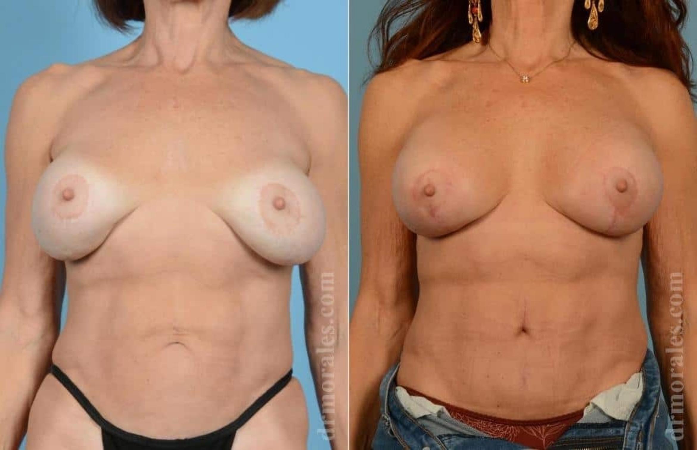 Before & After Breast Revision Case 46 View 1 View in Houston, TX