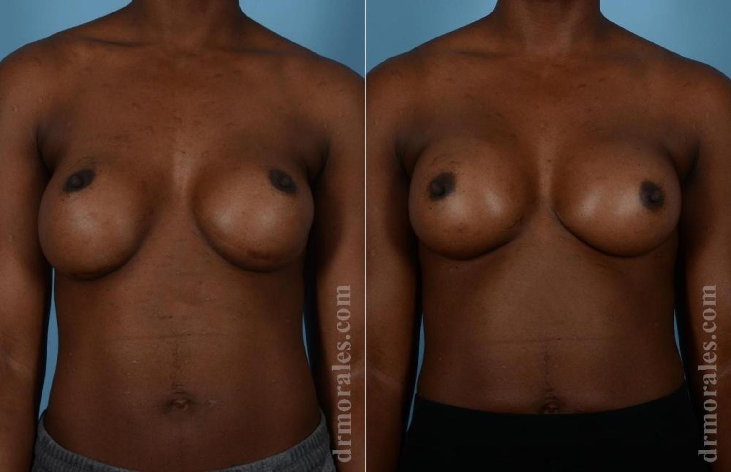 Before & After Breast Revision Case 47 View 1 View in Houston, TX