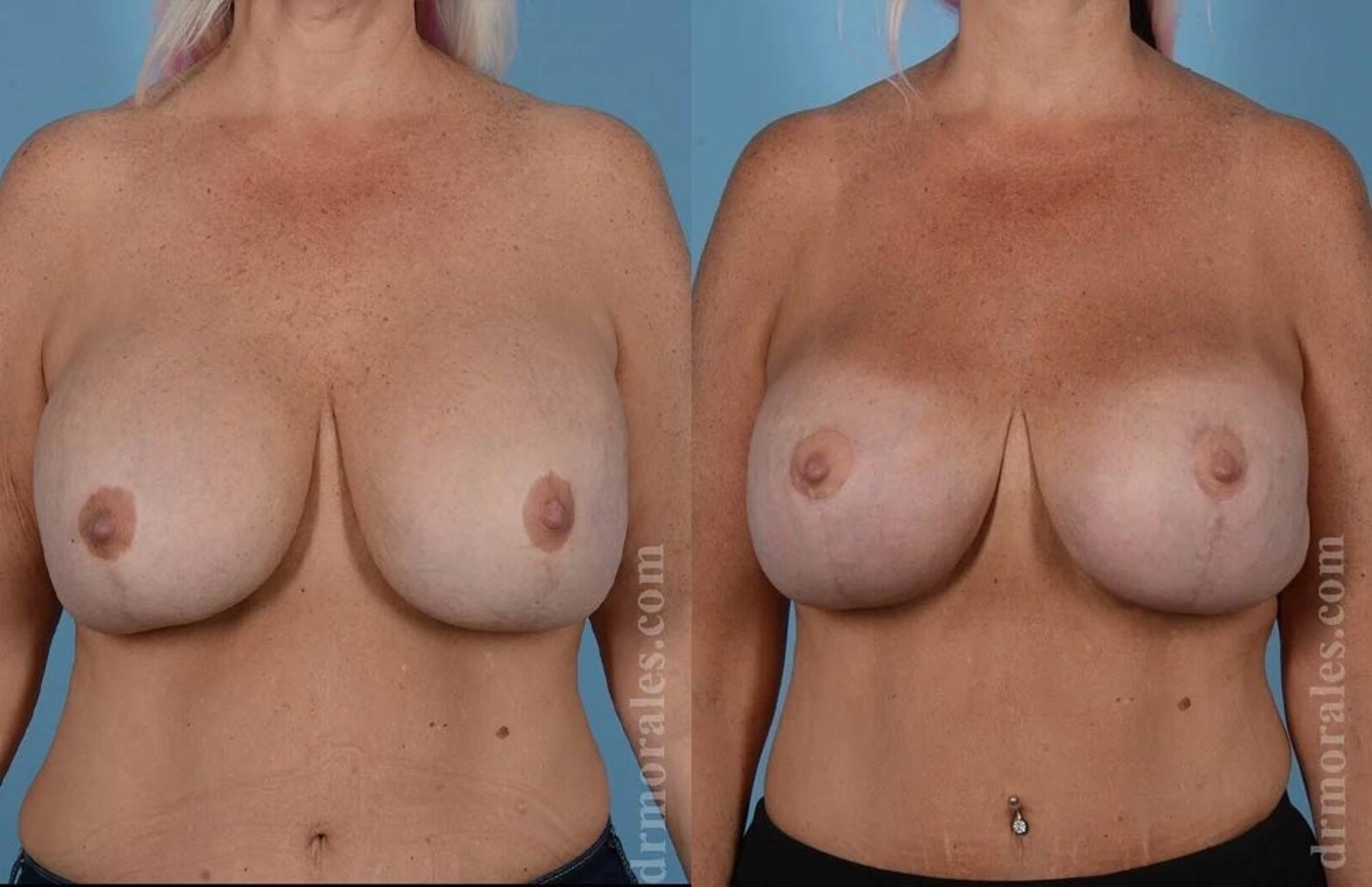 Before & After Breast Revision Case 572 View 1 View in Houston, TX