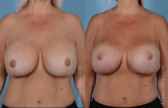 Before & After Breast Revision Case 572 View 1 View in Houston, TX