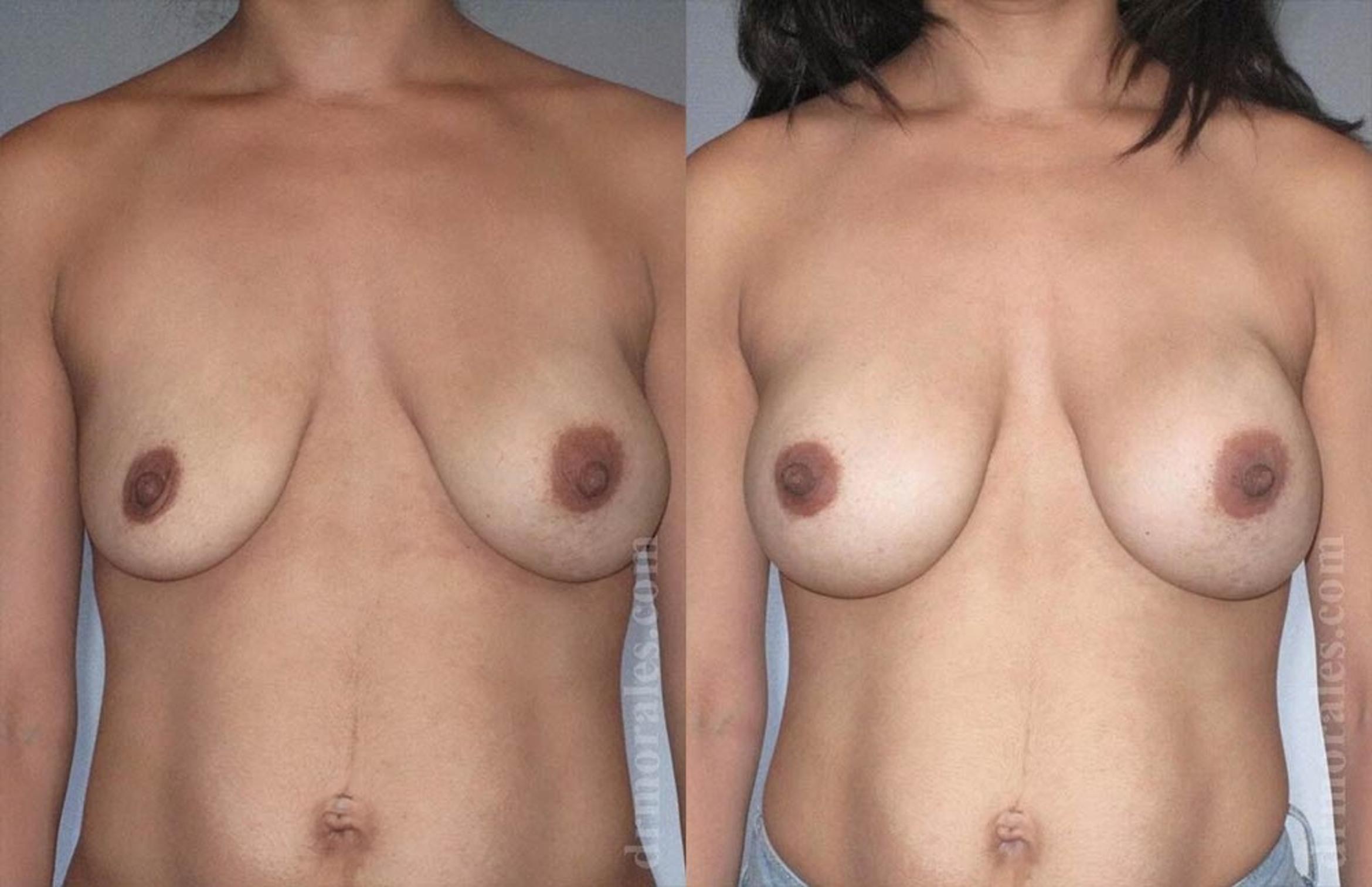Before & After Breast Revision Case 573 View 1 View in Houston, TX