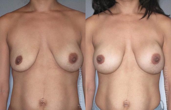 Before & After Breast Revision Case 573 View 1 View in Houston, TX