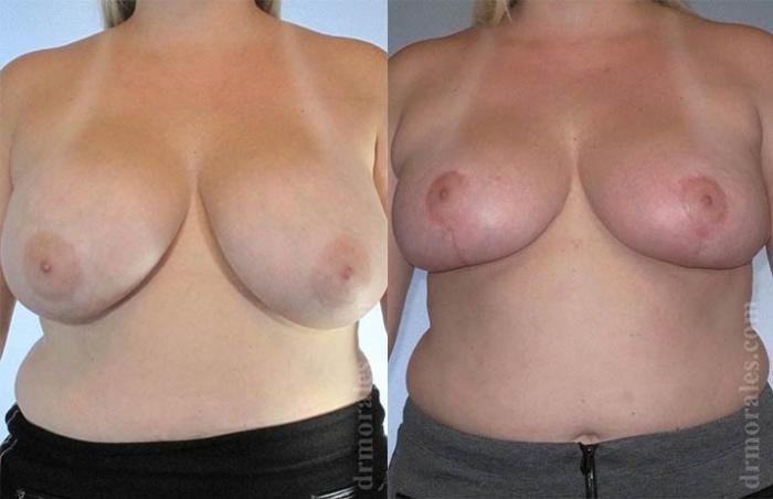 Before & After Breast Revision Case 574 View 1 View in Houston, TX