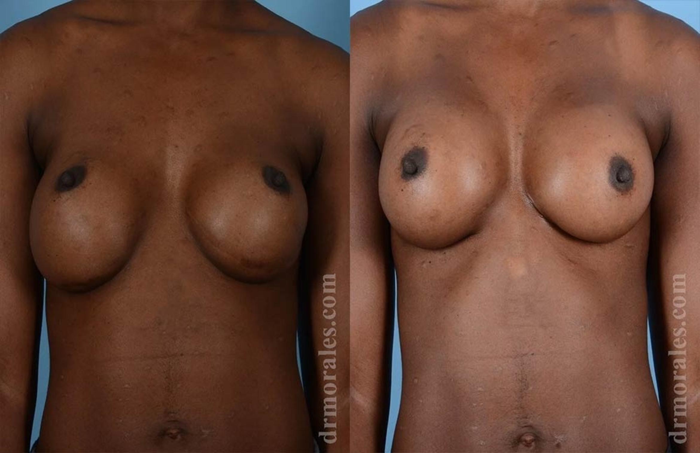 Before & After Breast Revision Case 576 View 1 View in Houston, TX