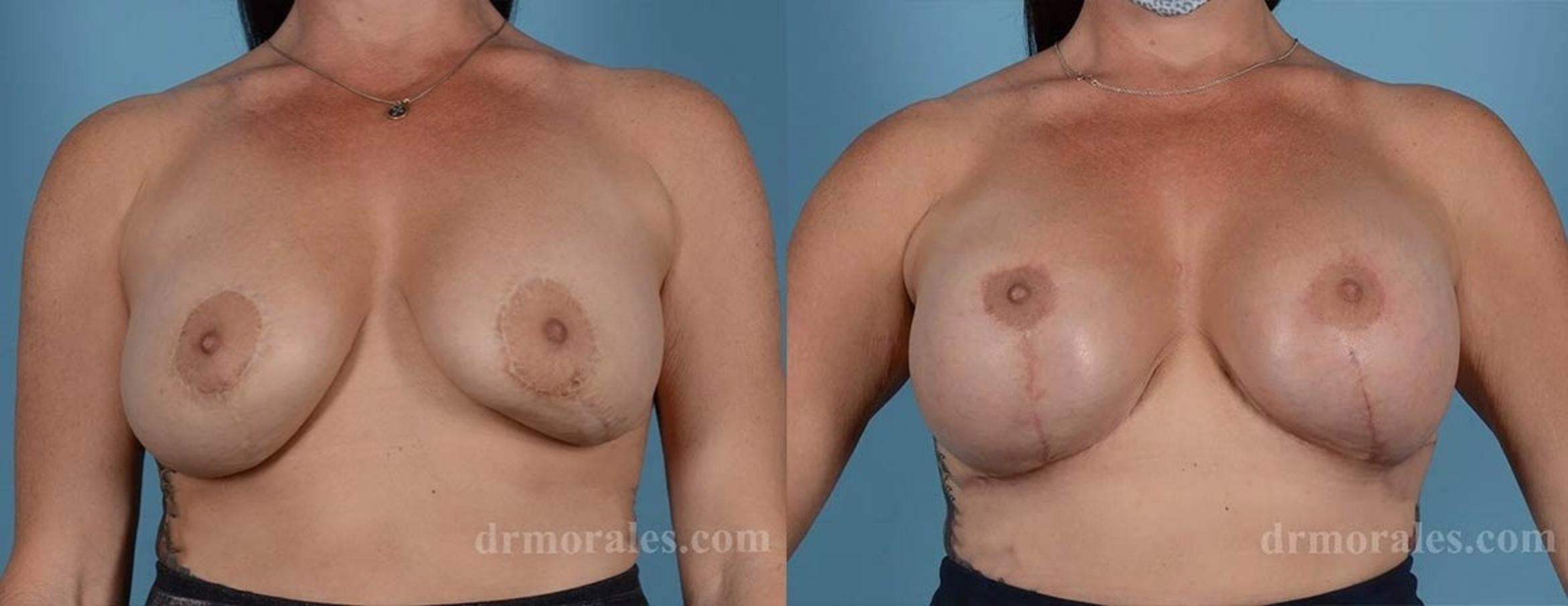 Before & After Breast Revision Case 577 View 1 View in Houston, TX