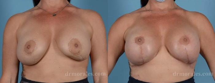 Before & After Breast Revision Case 577 View 1 View in Houston, TX