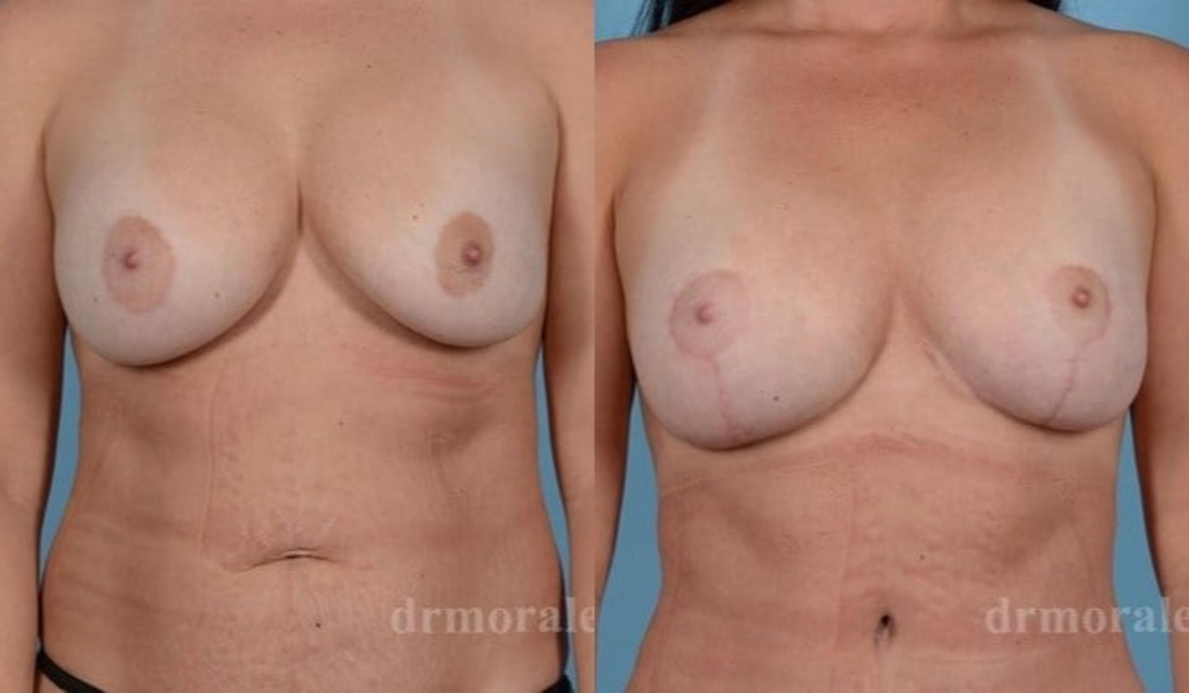 Before & After Breast Revision Case 583 View 1 View in Houston, TX