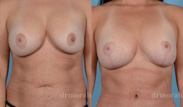 Before & After Breast Revision Case 583 View 1 View in Houston, TX