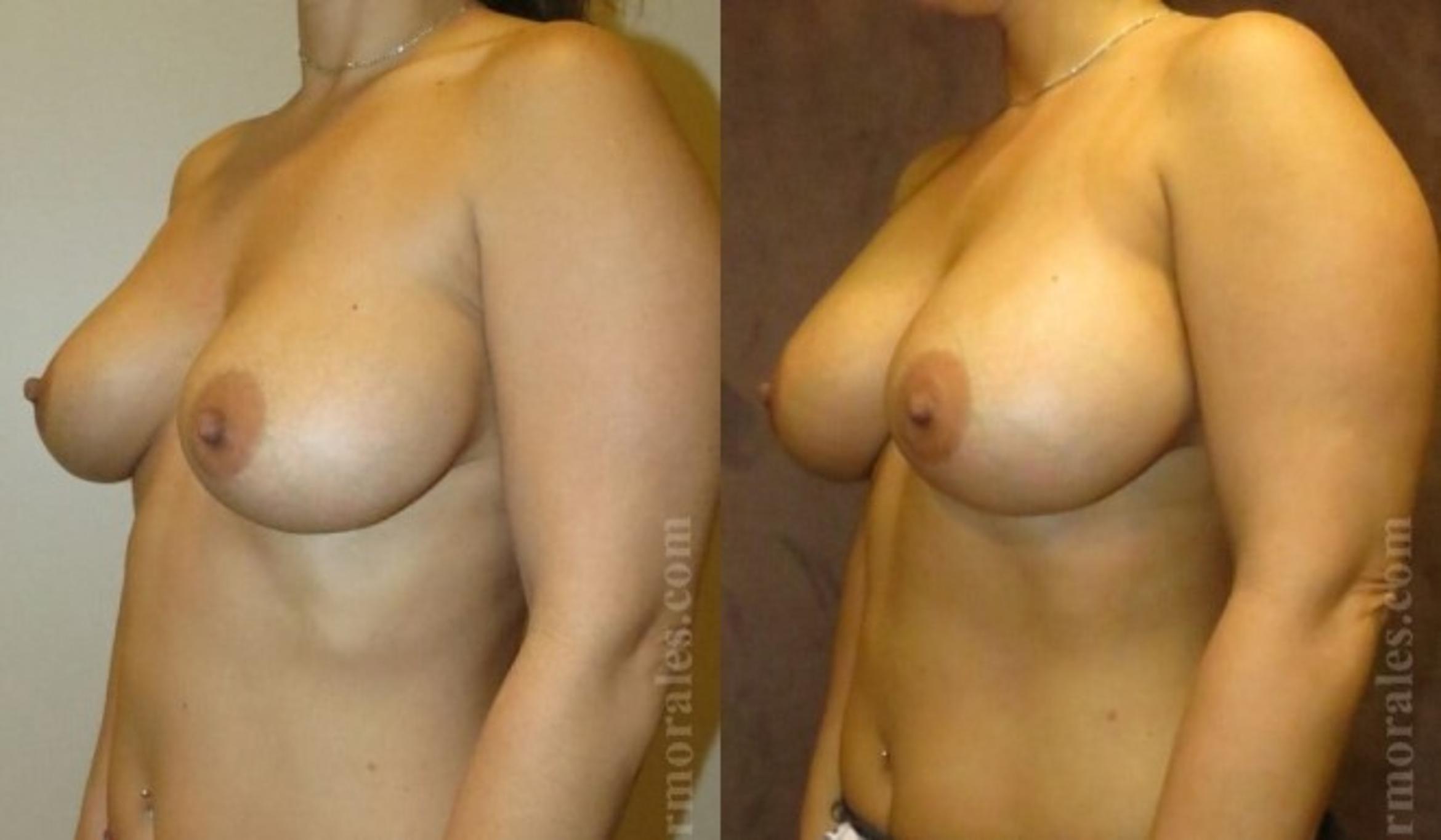 Before & After Breast Revision Case 585 View 1 View in Houston, TX