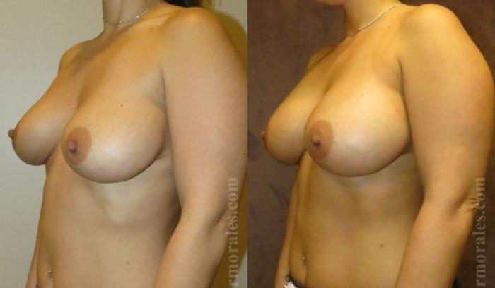 Before & After Breast Revision Case 585 View 1 View in Houston, TX