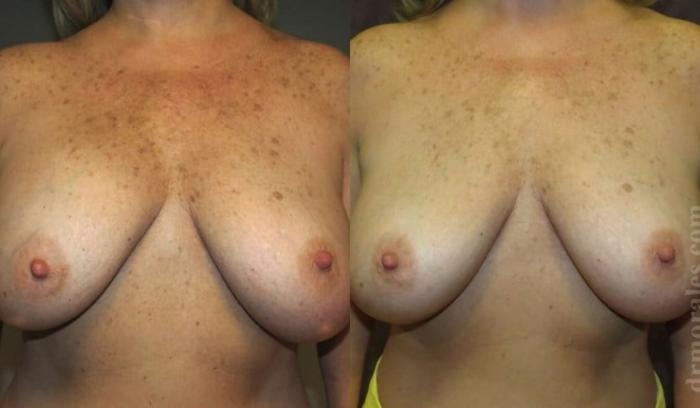 Before & After Breast Revision Case 586 View 1 View in Houston, TX