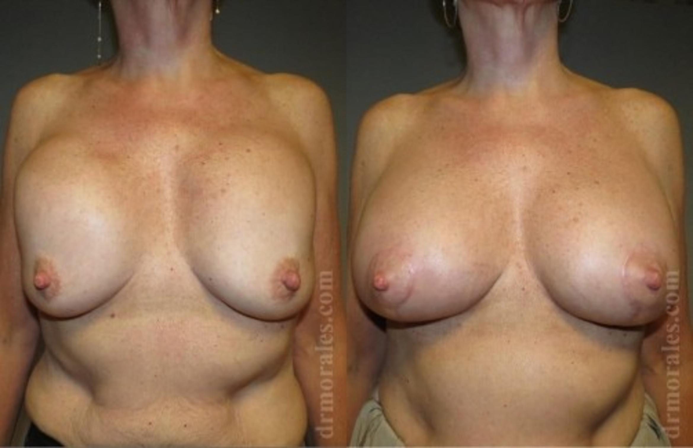 Before & After Breast Revision Case 587 View 1 View in Houston, TX