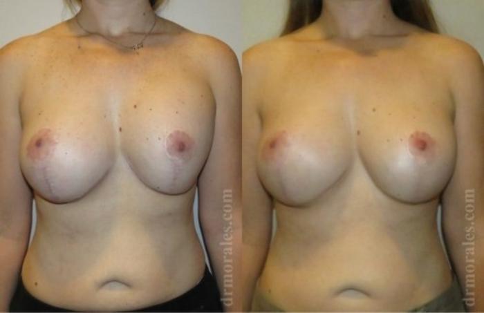 Before & After Breast Revision Case 589 View 1 View in Houston, TX