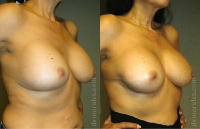 Before & After Breast Revision Case 590 View 1 View in Houston, TX