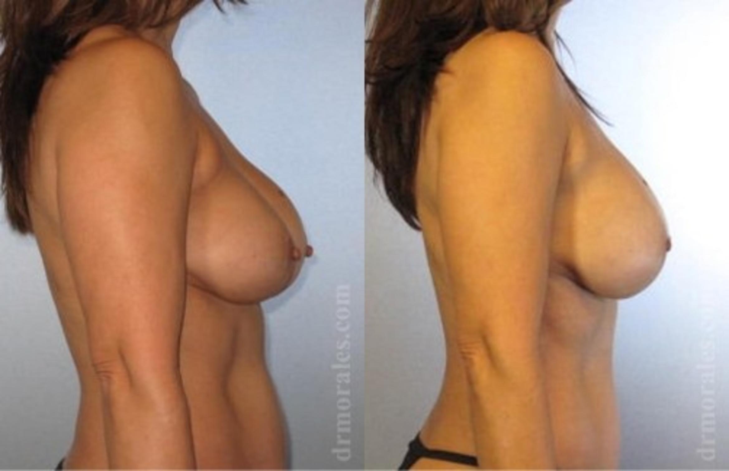 Before & After Breast Revision Case 591 View 1 View in Houston, TX