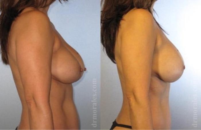 Before & After Breast Revision Case 591 View 1 View in Houston, TX