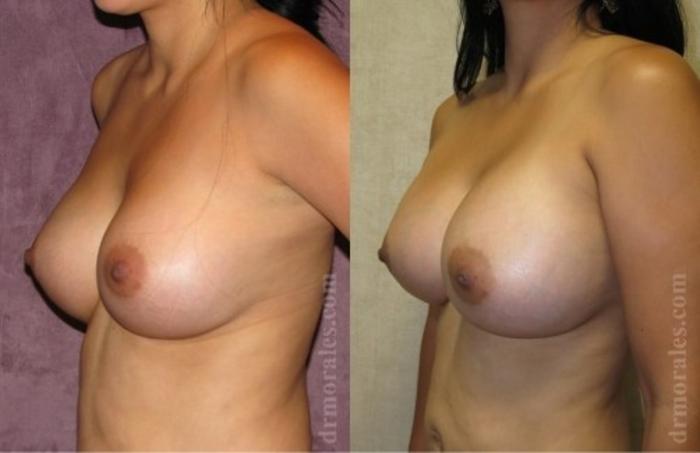 Before & After Breast Revision Case 593 View 1 View in Houston, TX