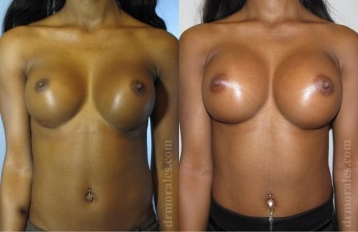 Before & After Breast Revision Case 594 View 1 View in Houston, TX