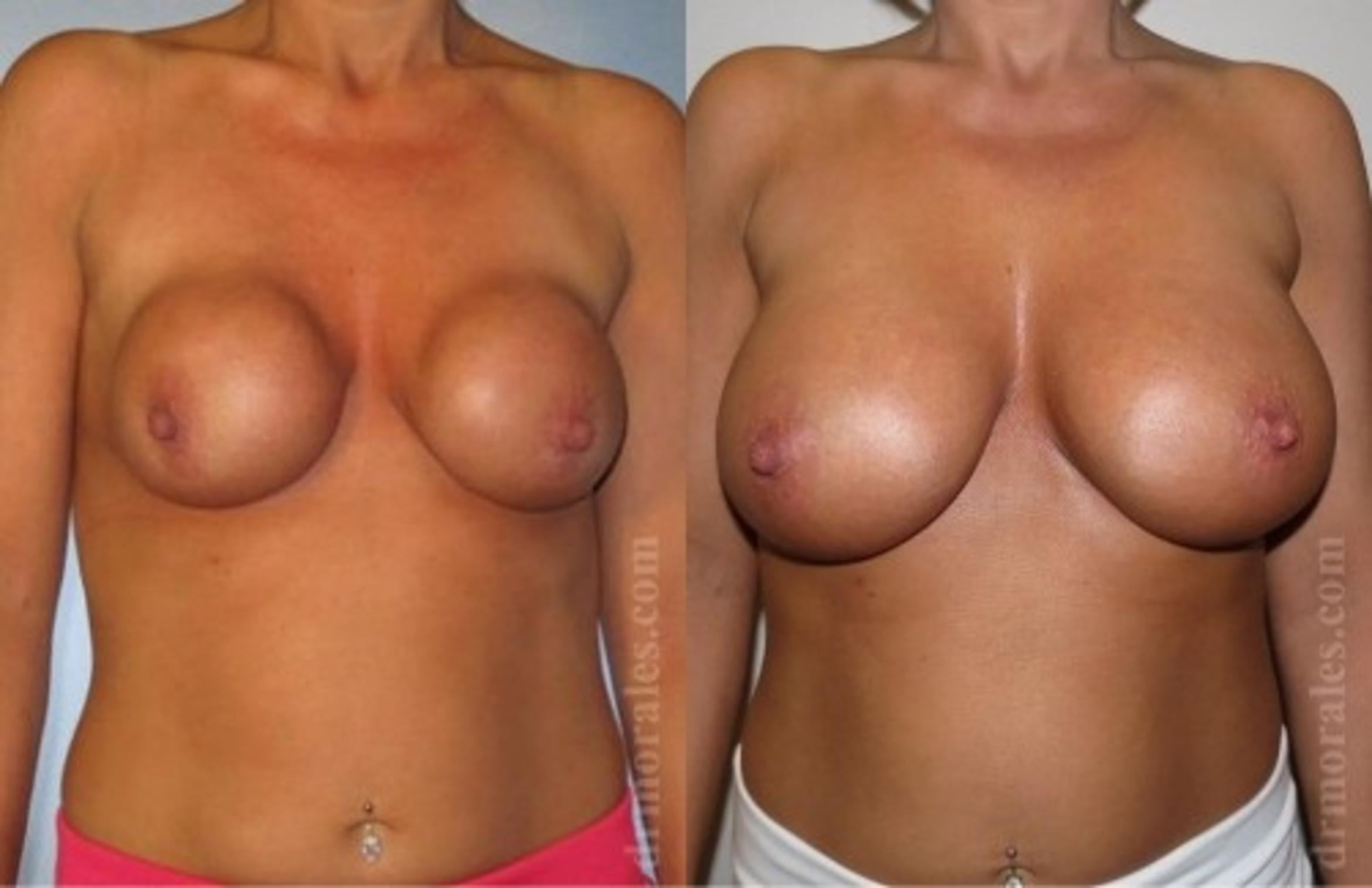 Before & After Breast Revision Case 595 View 1 View in Houston, TX