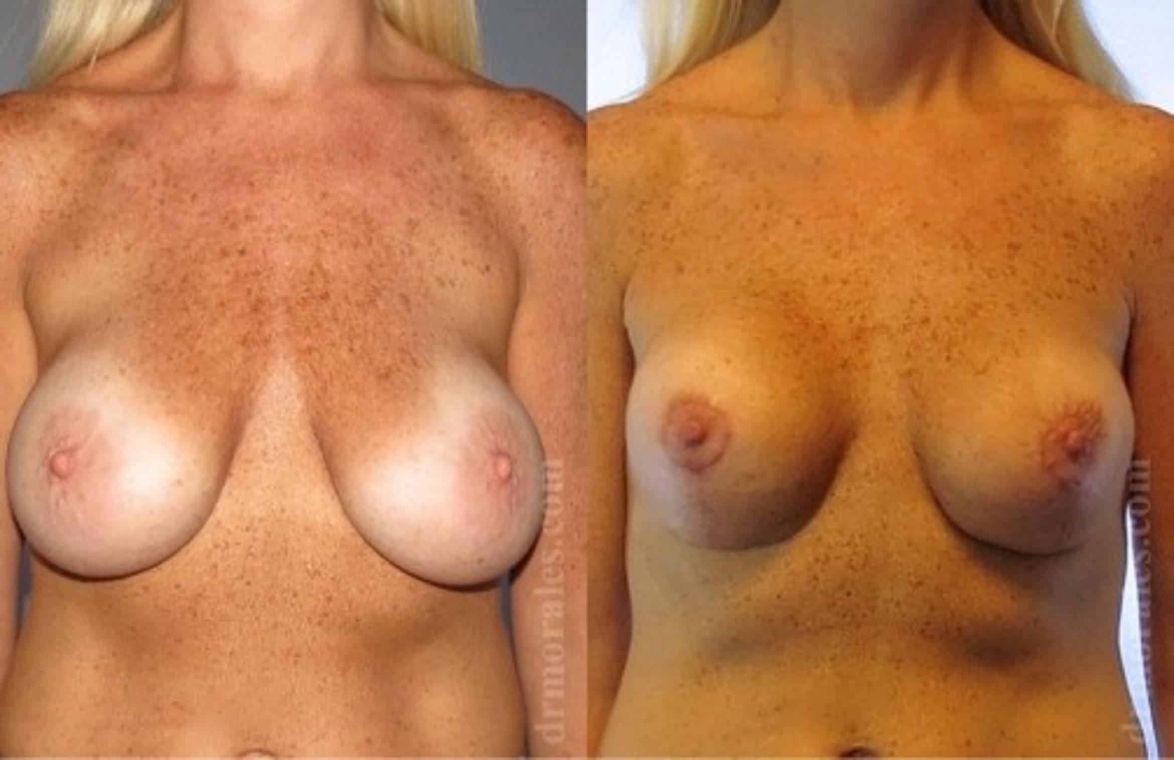 Before & After Breast Revision Case 596 View 1 View in Houston, TX
