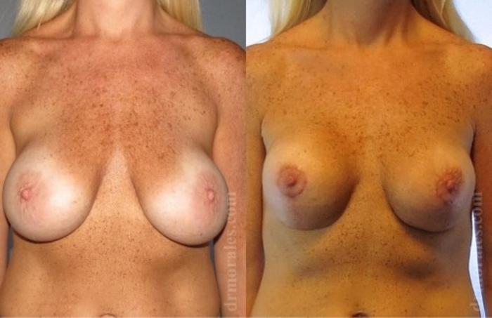 Before & After Breast Revision Case 596 View 1 View in Houston, TX