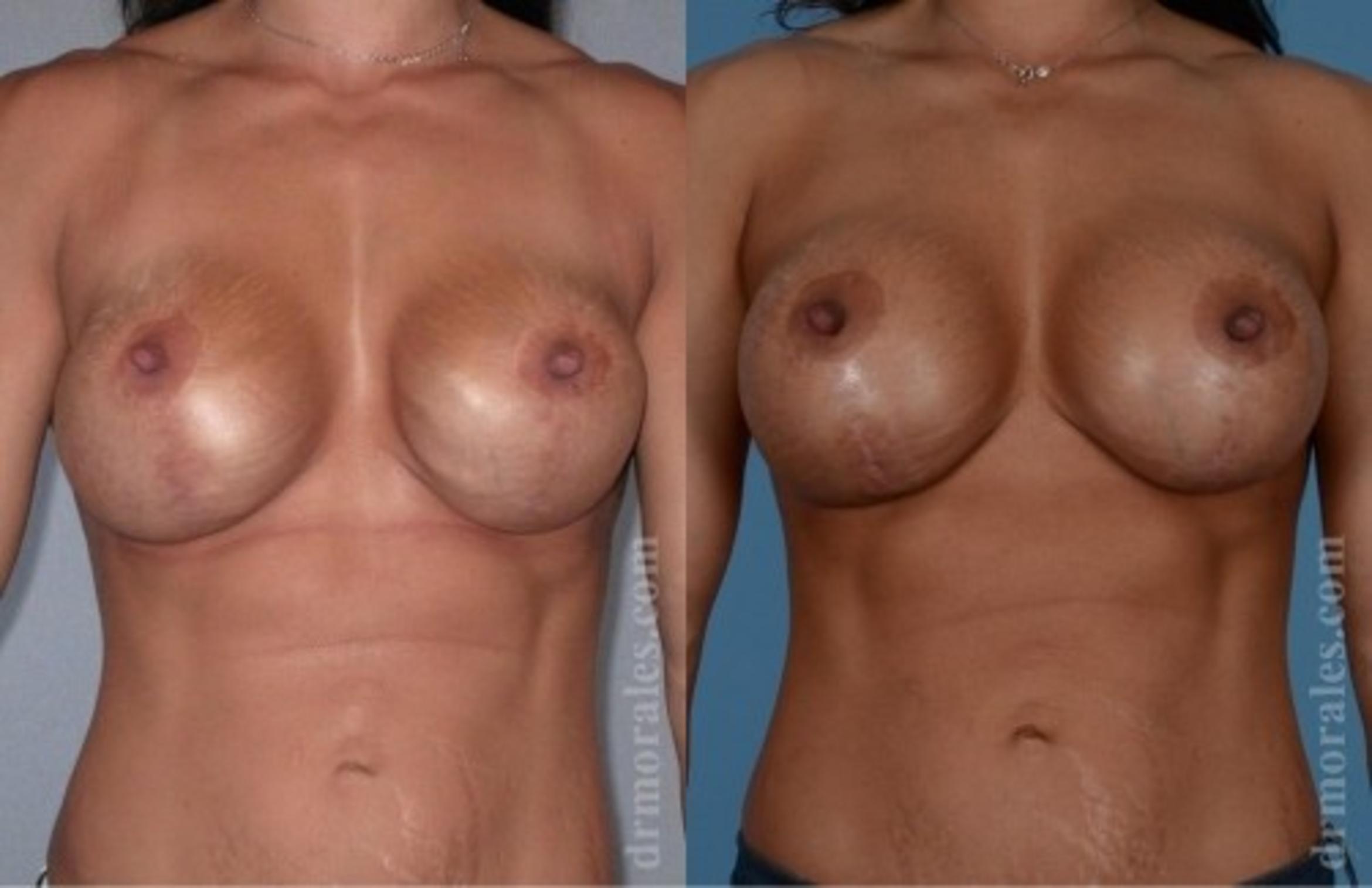 Before & After Breast Revision Case 598 View 1 View in Houston, TX