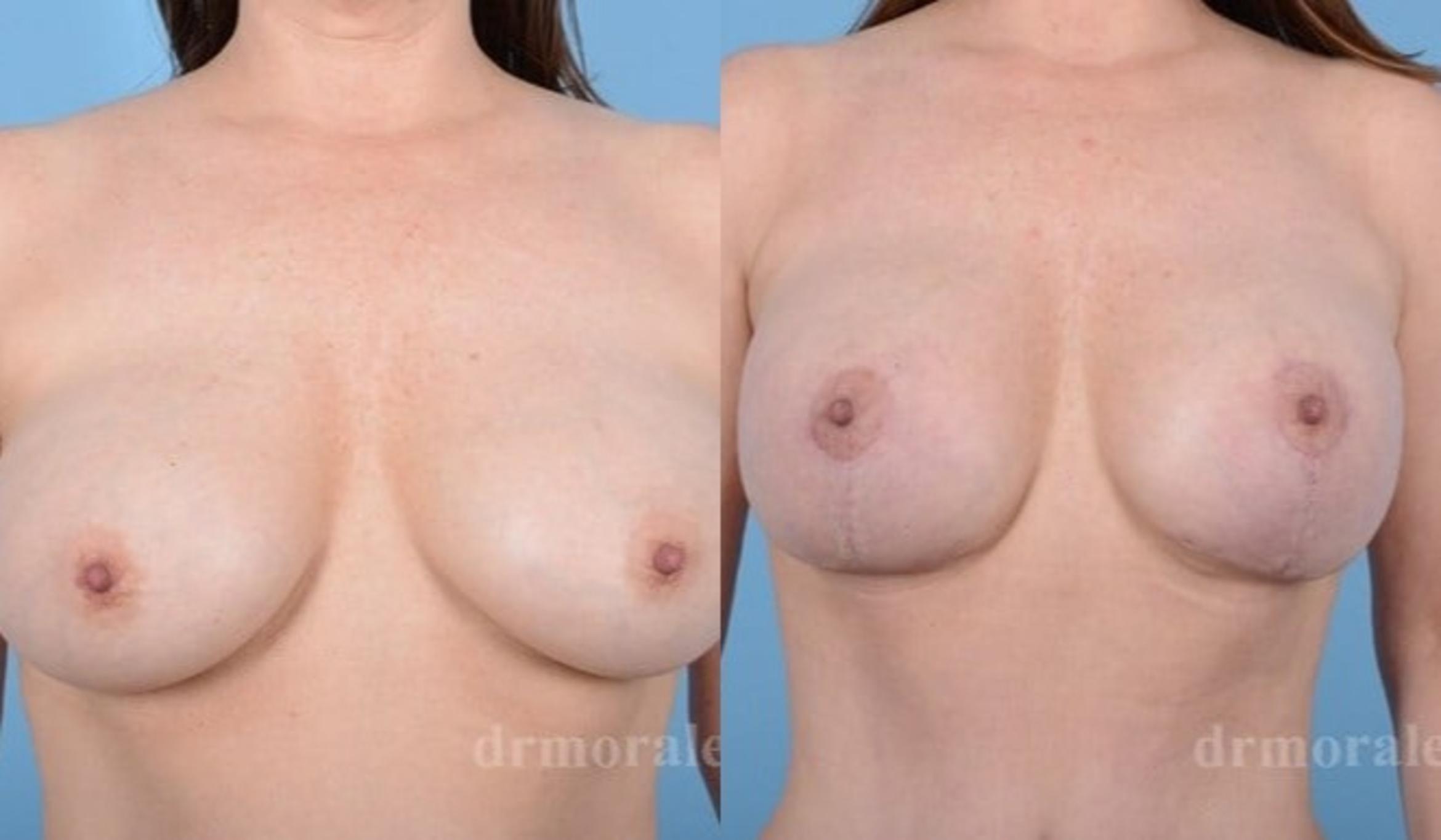 Before & After Breast Revision Case 599 View 1 View in Houston, TX