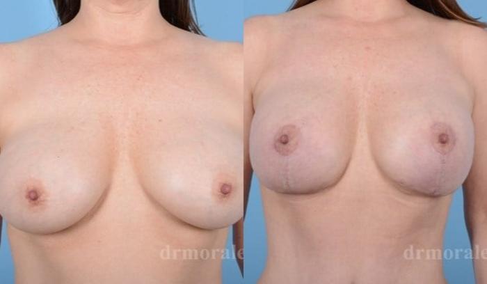 Before & After Breast Revision Case 599 View 1 View in Houston, TX