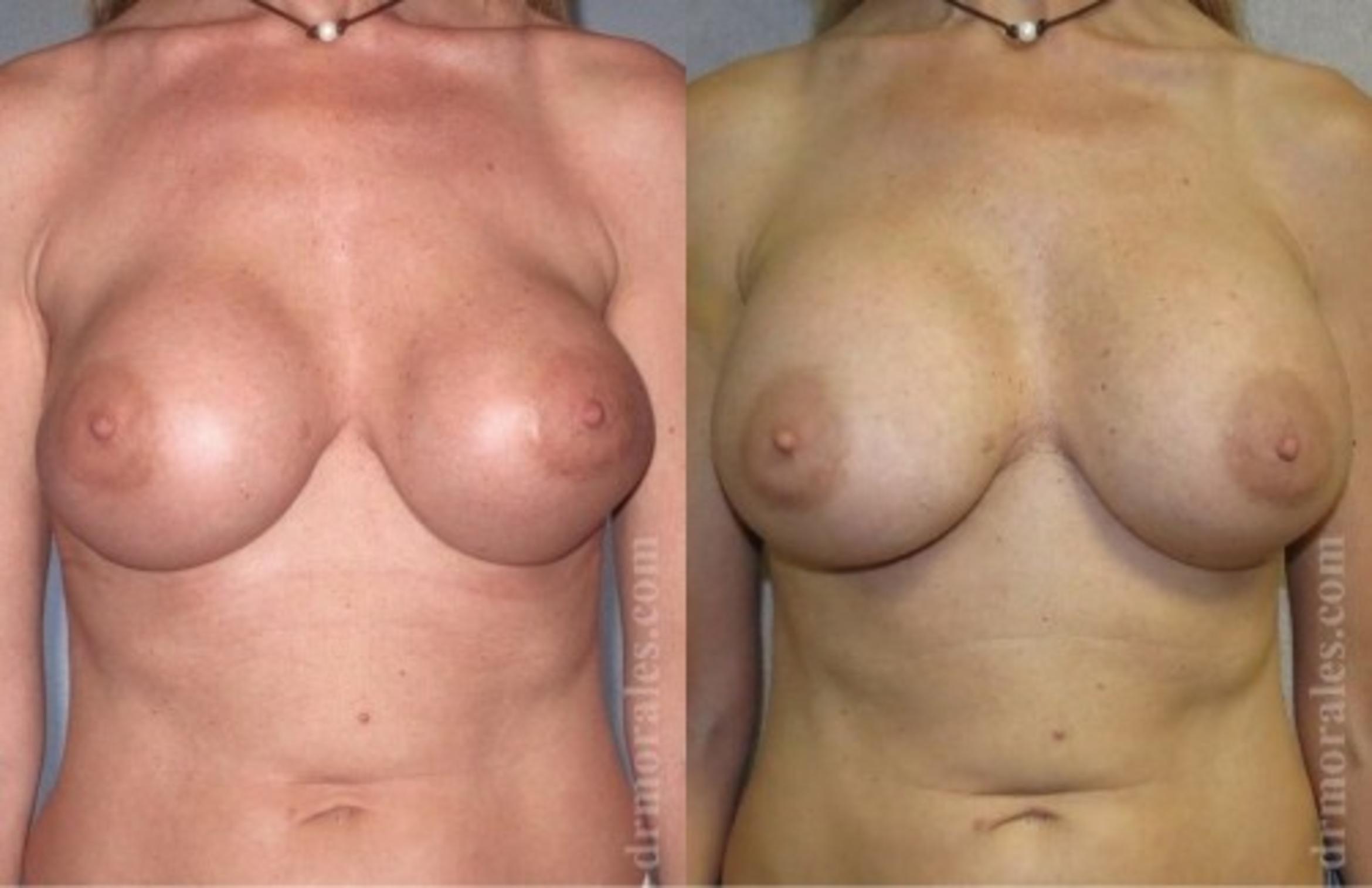 Before & After Breast Revision Case 600 View 1 View in Houston, TX