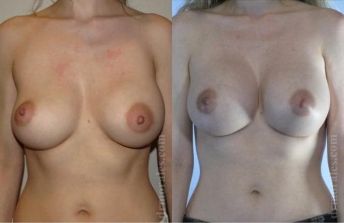 Before & After Breast Revision Case 601 View 1 View in Houston, TX
