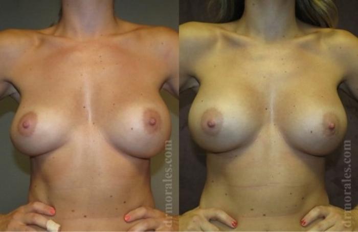 Before & After Breast Revision Case 602 View 1 View in Houston, TX