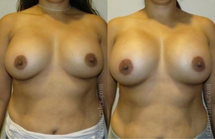 Before & After Breast Revision Case 603 View 1 View in Houston, TX