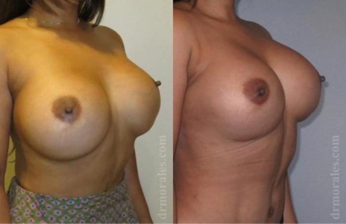 Before & After Breast Revision Case 604 View 1 View in Houston, TX