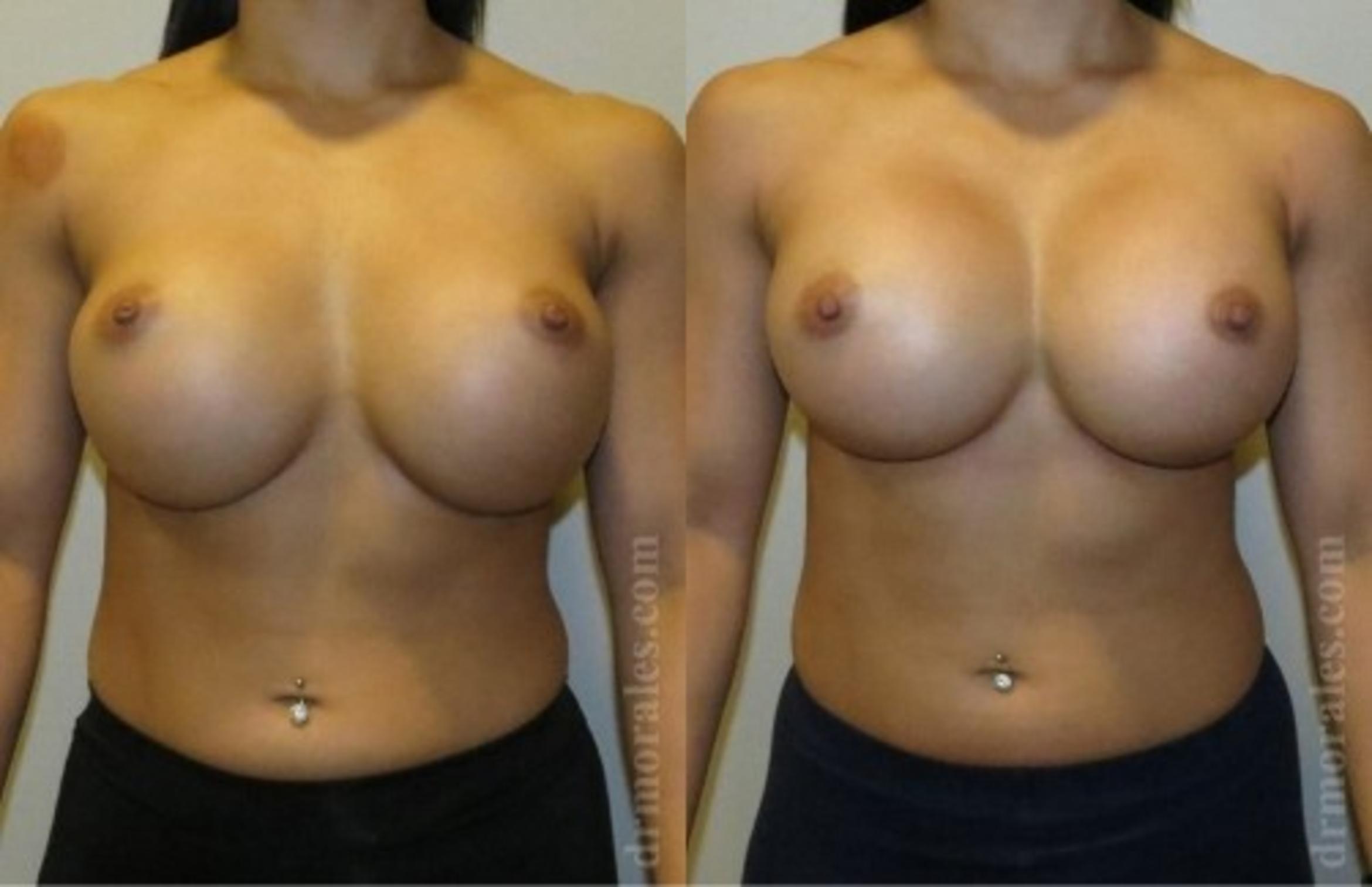 Before & After Breast Revision Case 605 View 1 View in Houston, TX