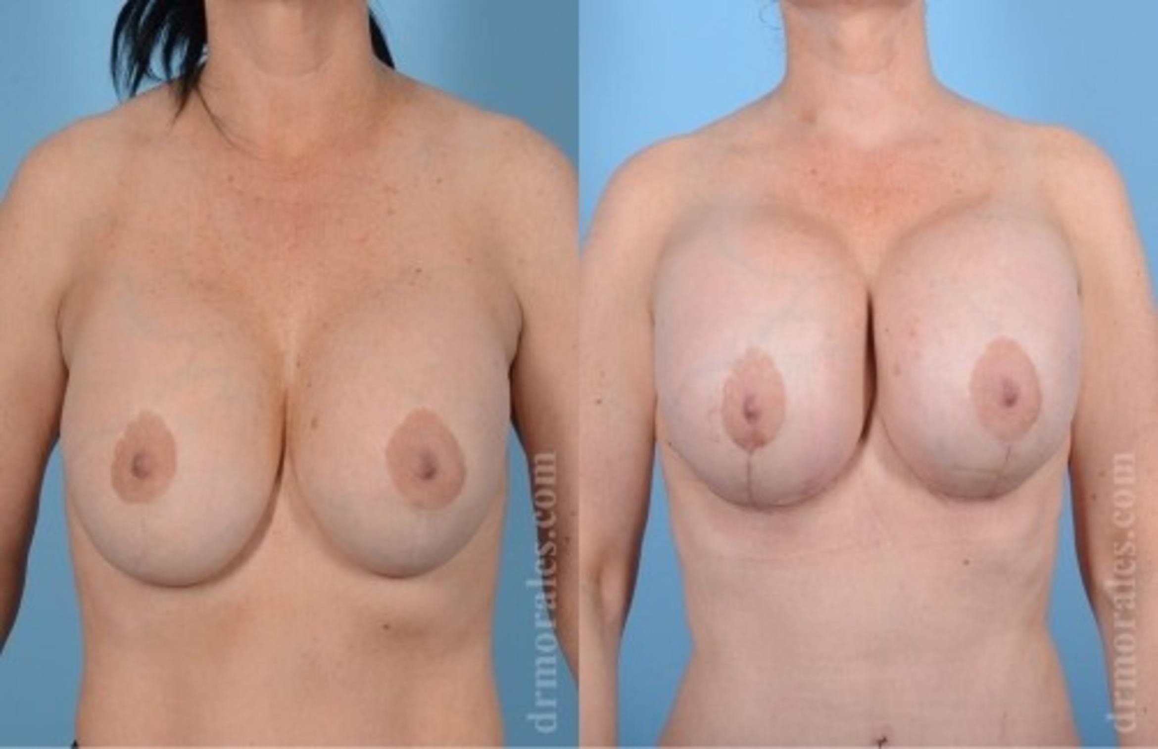 Before & After Breast Revision Case 606 View 1 View in Houston, TX