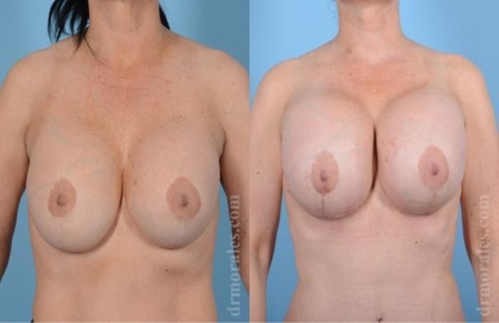 Before & After Breast Revision Case 606 View 1 View in Houston, TX