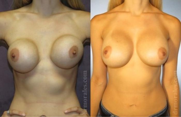 Before & After Breast Revision Case 609 View 1 View in Houston, TX