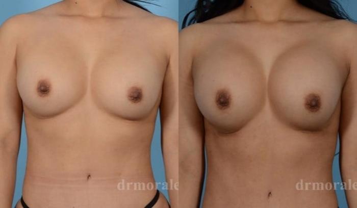 Before & After Breast Revision Case 610 View 1 View in Houston, TX