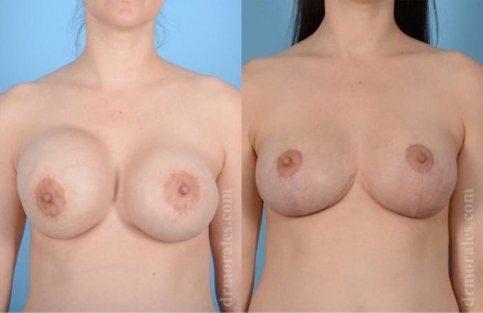 Before & After Breast Revision Case 612 View 1 View in Houston, TX