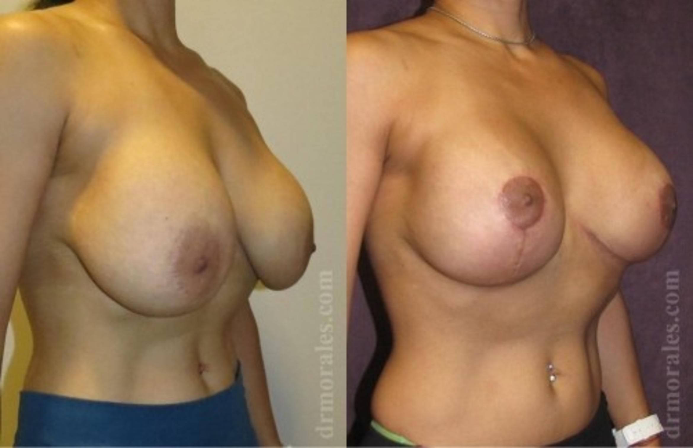 Before & After Breast Revision Case 614 View 1 View in Houston, TX