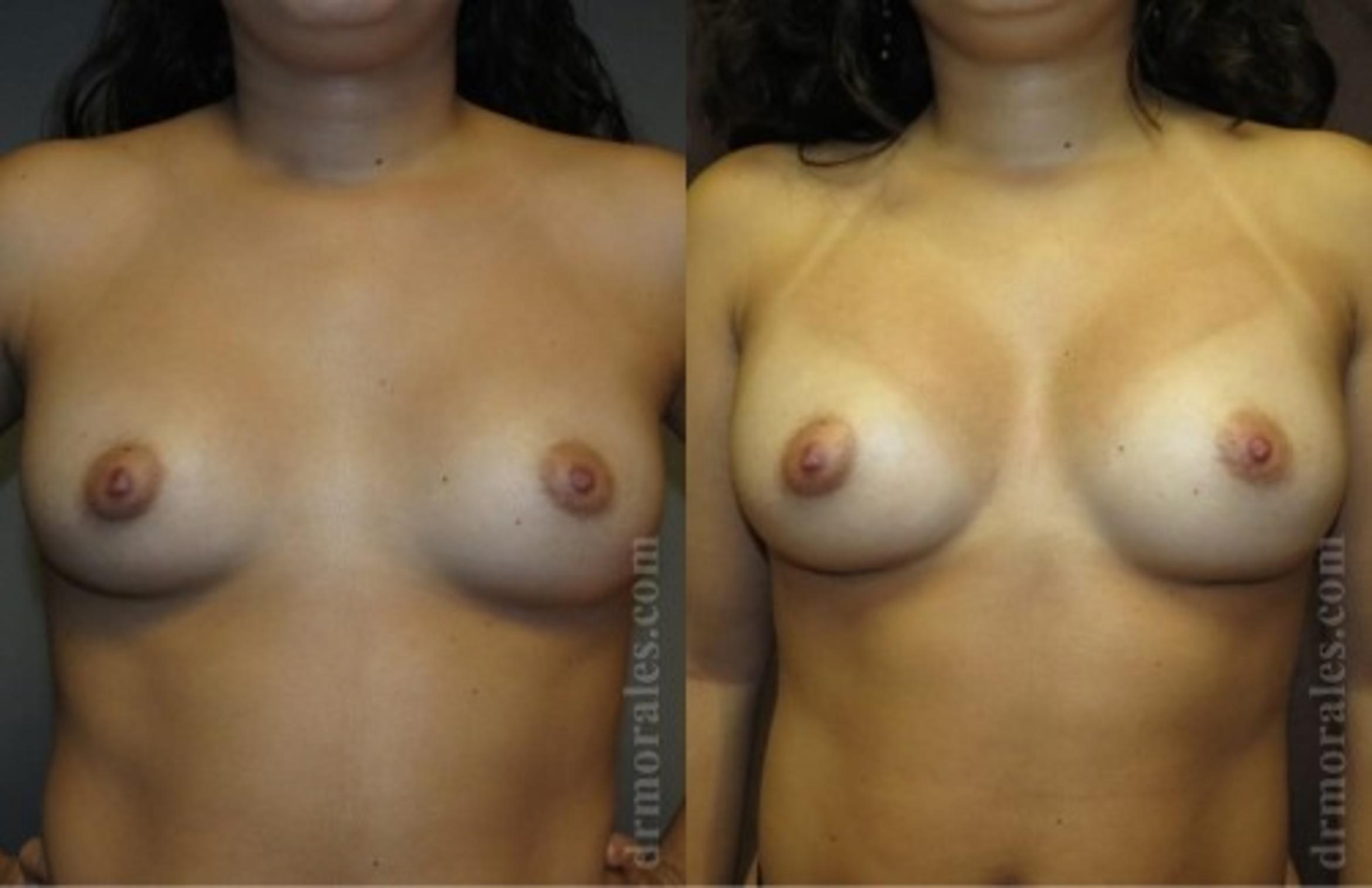 Before & After Breast Revision Case 616 View 1 View in Houston, TX