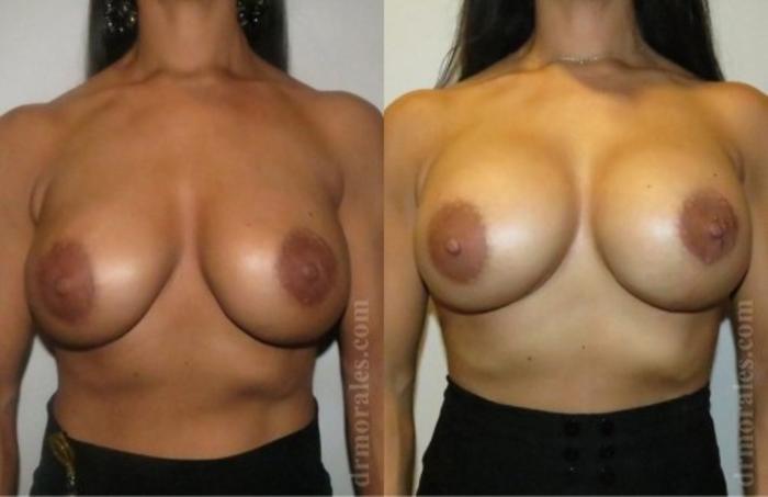 Before & After Breast Revision Case 617 View 1 View in Houston, TX