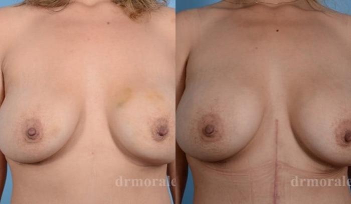 Before & After Breast Revision Case 618 View 1 View in Houston, TX