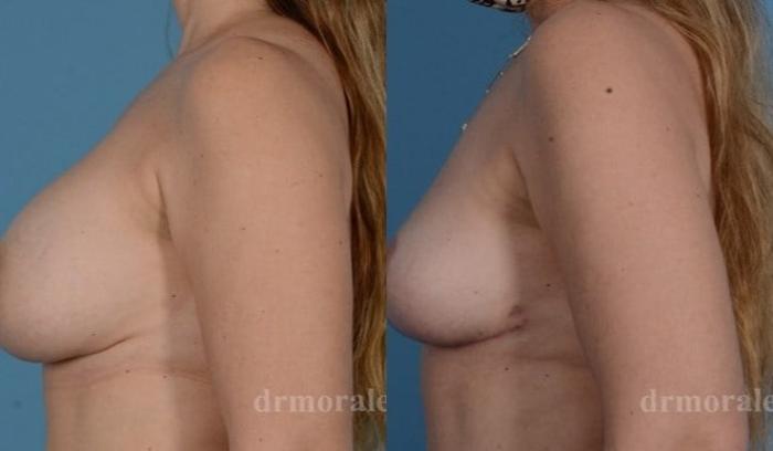 Before & After Breast Revision Case 620 View 1 View in Houston, TX