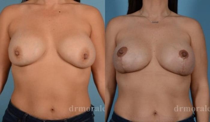 Before & After Breast Revision Case 621 View 1 View in Houston, TX