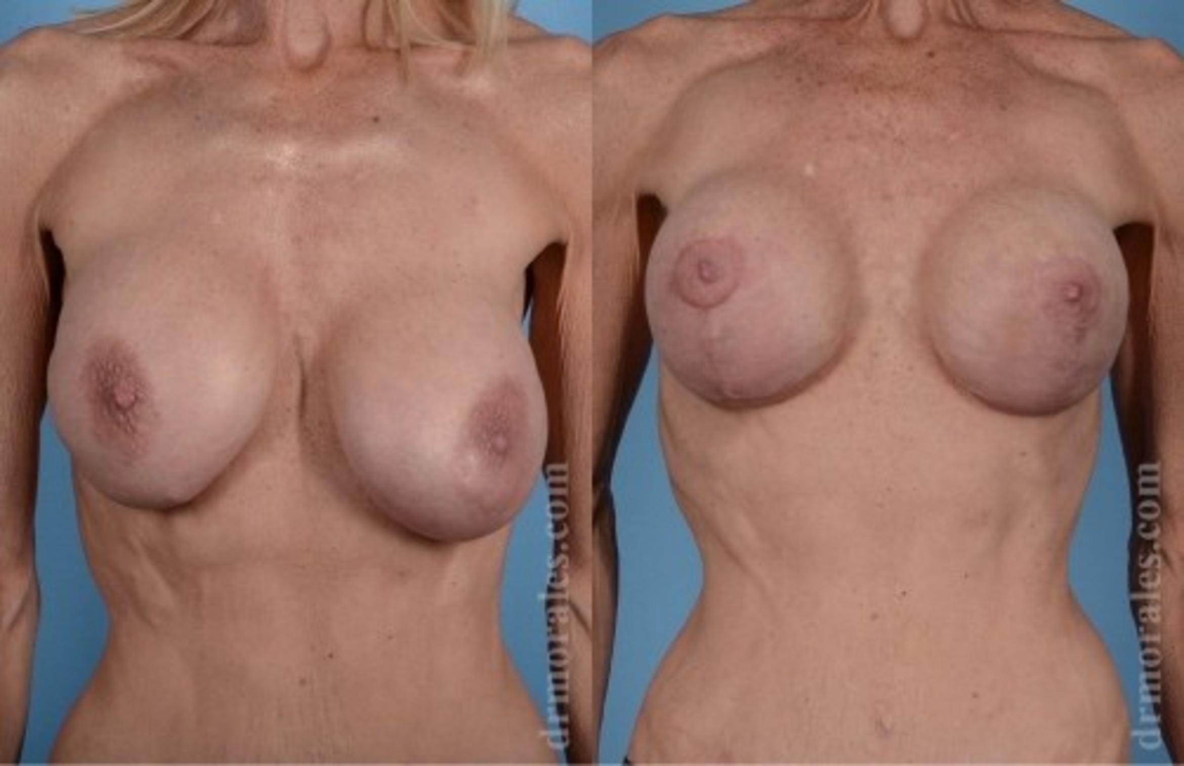 Before & After Breast Revision Case 626 View 1 View in Houston, TX